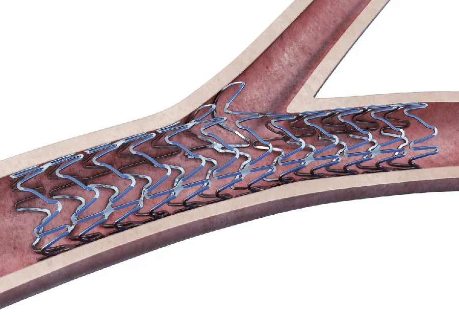 Bifurkasyon lezyonunda stent apozisyonu ve yan dal tedavisi